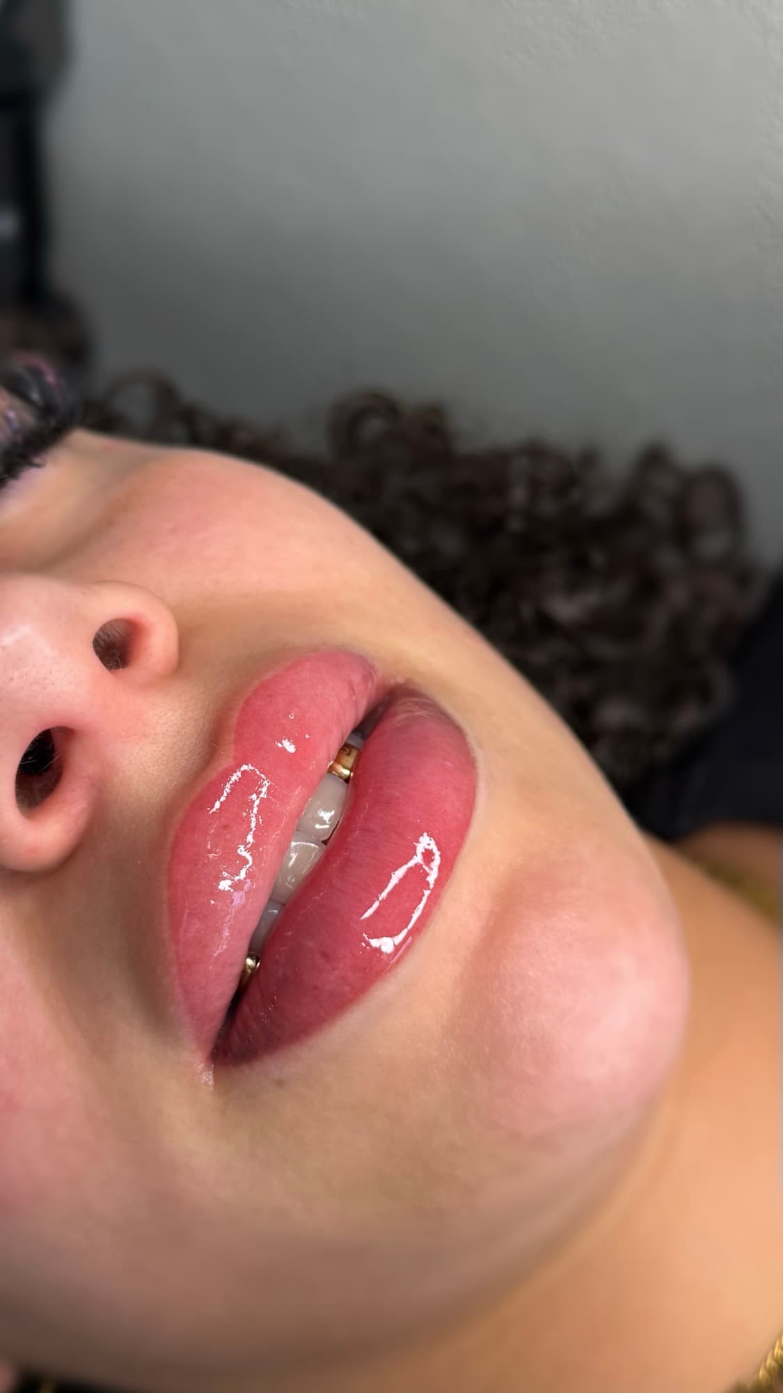 Resultaat van een lipbehandeling.