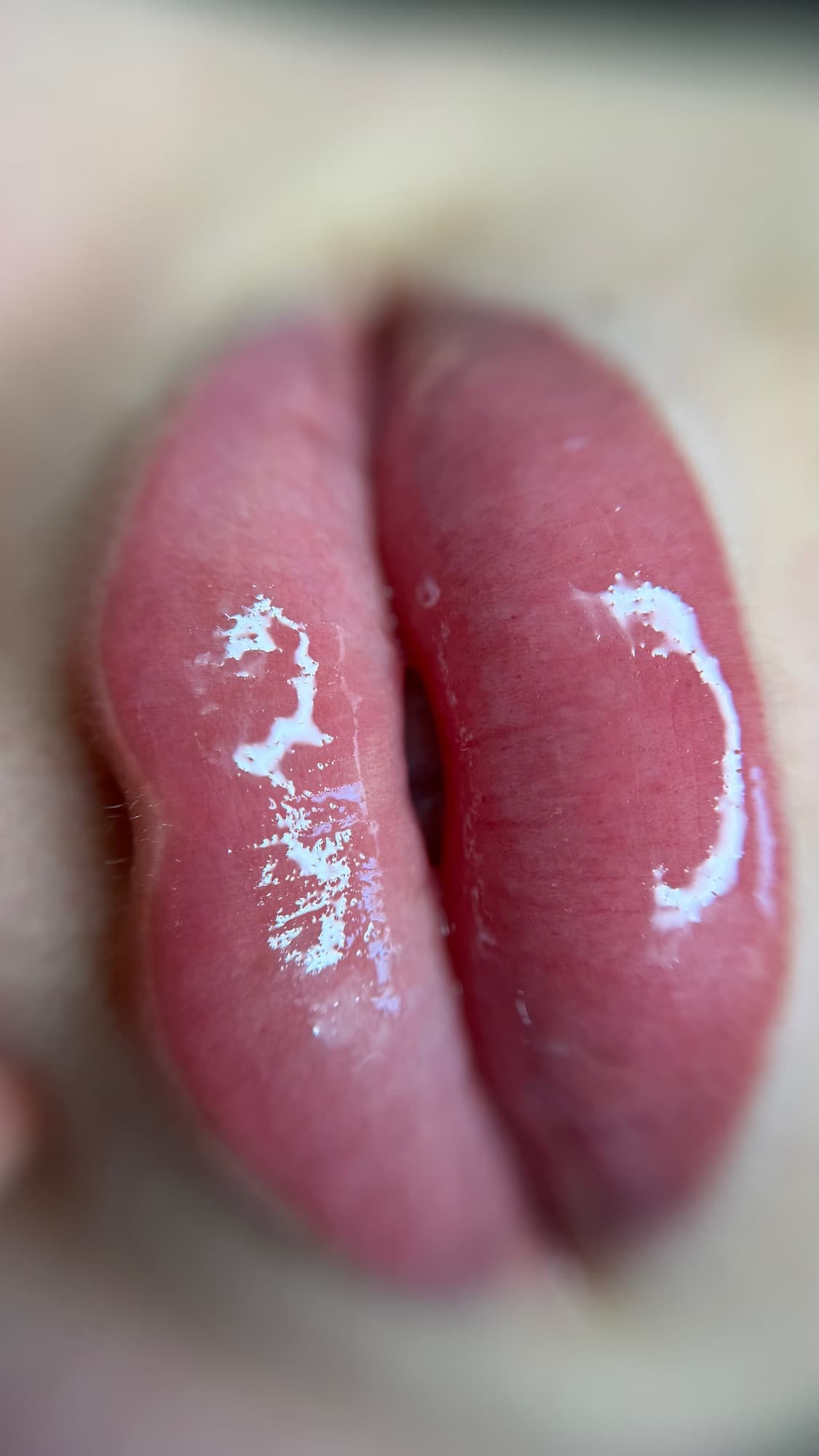 Resultaat van een lipbehandeling.