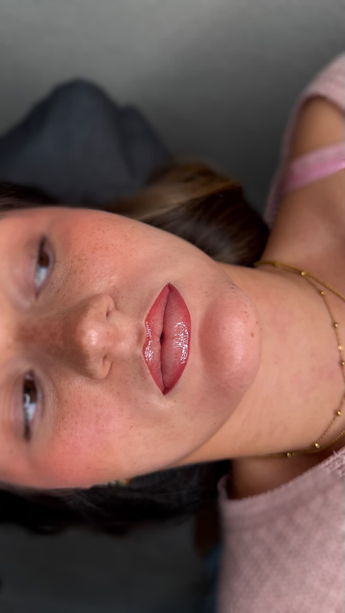 Resultaat van een lipbehandeling.