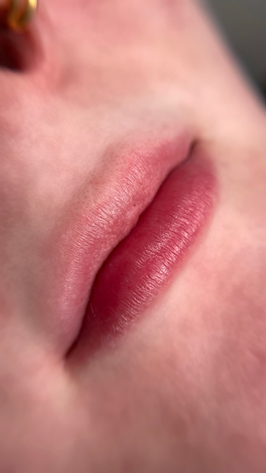 Resultaat van een lipbehandeling.