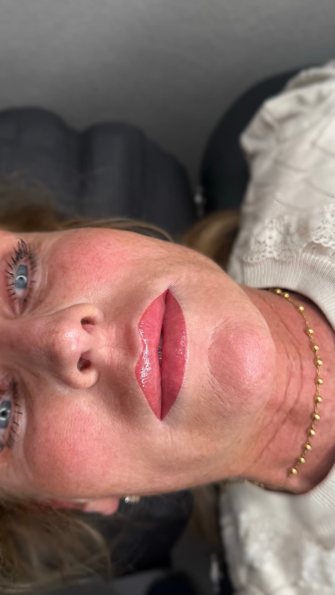 Resultaat van een lipbehandeling.