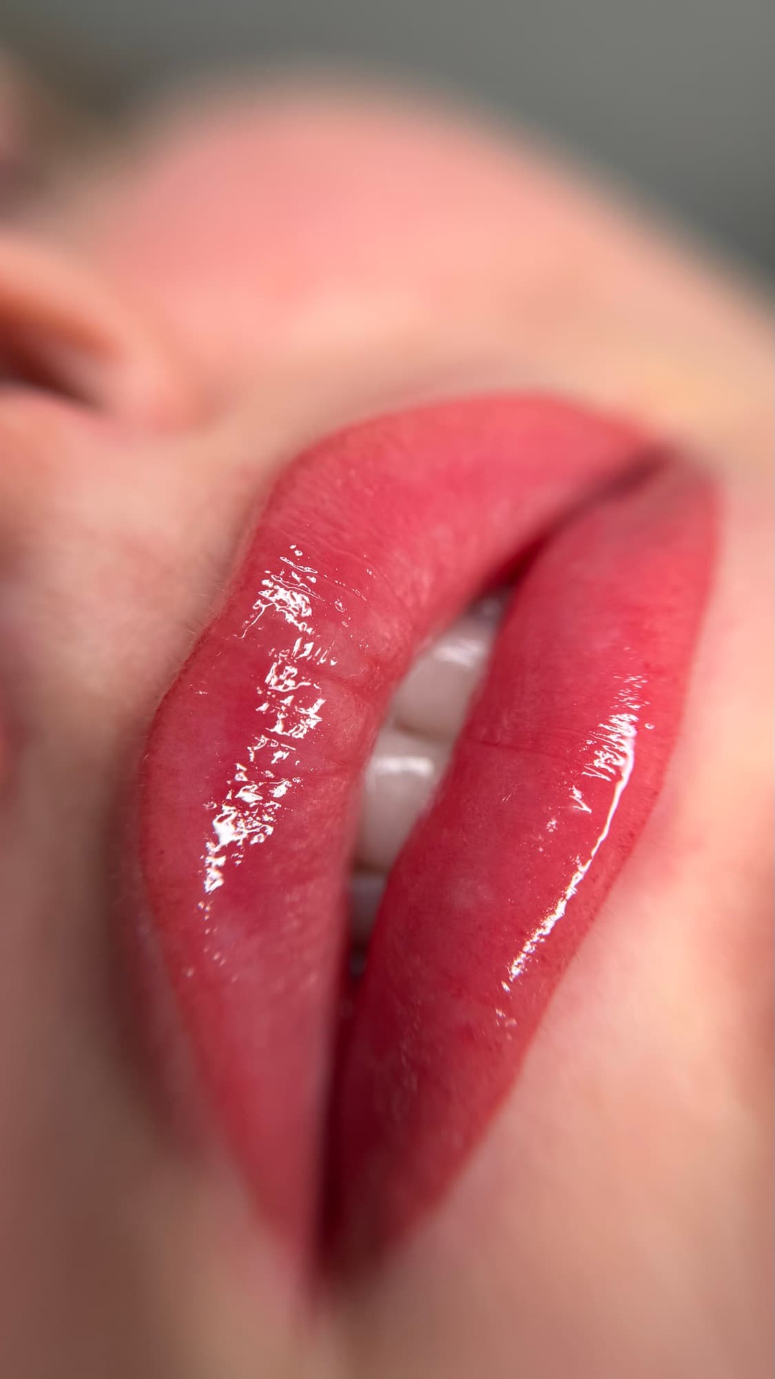 Resultaat van een lipbehandeling.