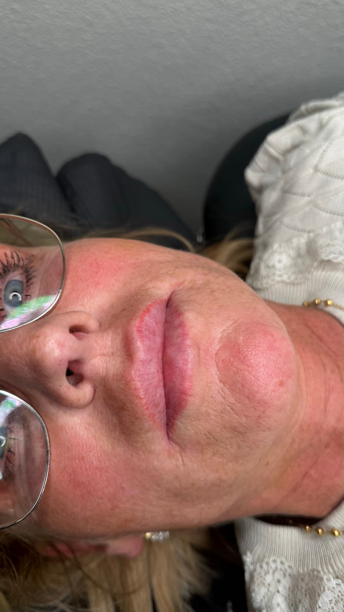 Resultaat van een lipbehandeling.