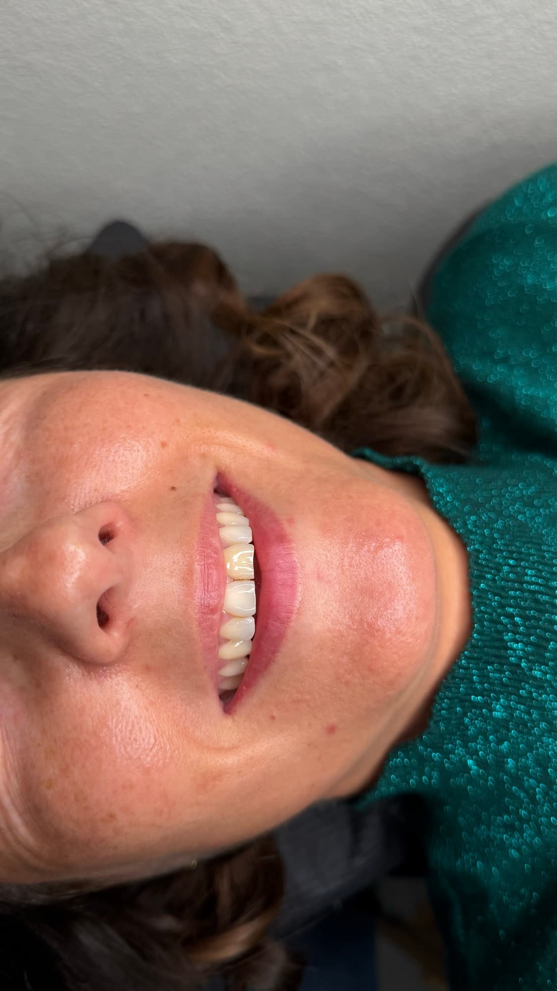 Resultaat van een lipbehandeling.