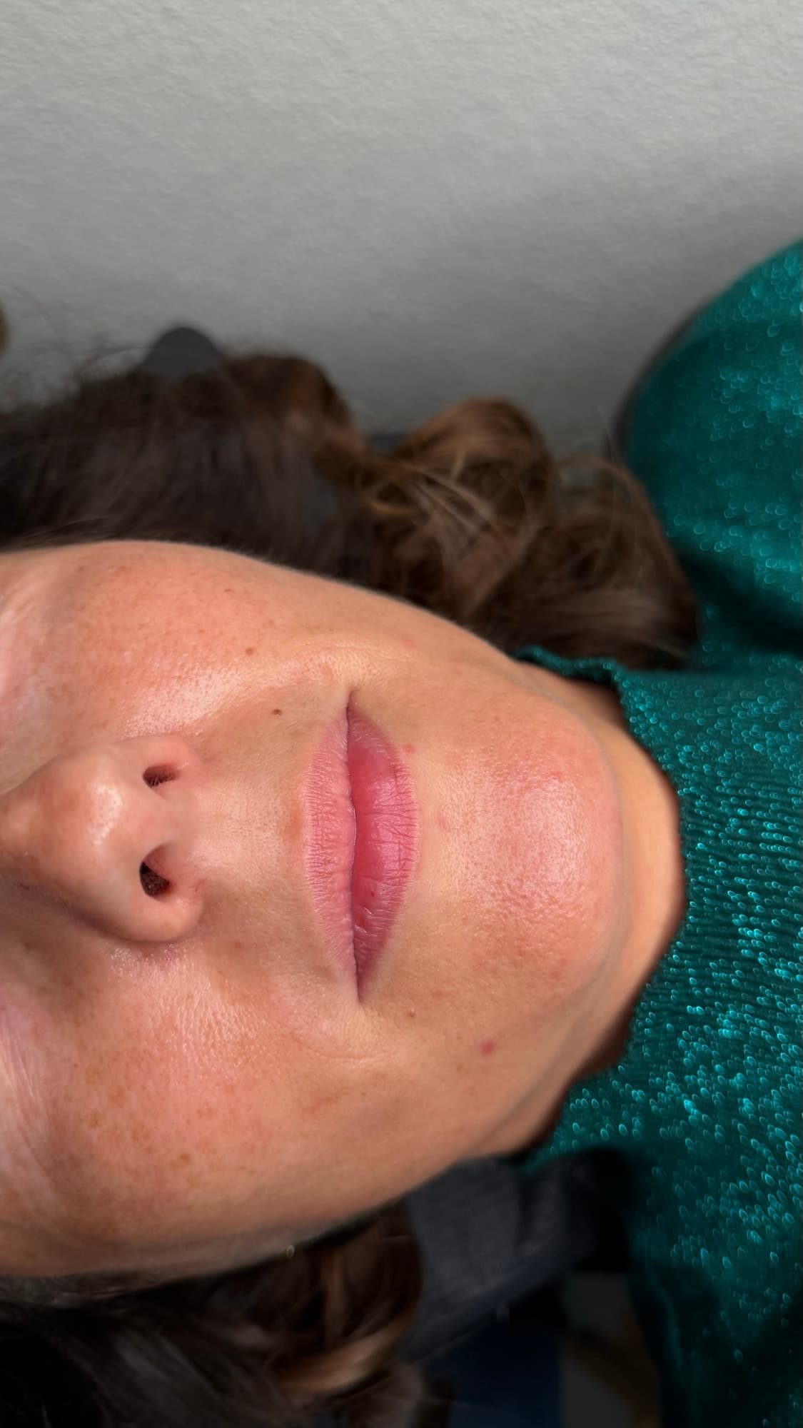 Resultaat van een lipbehandeling.