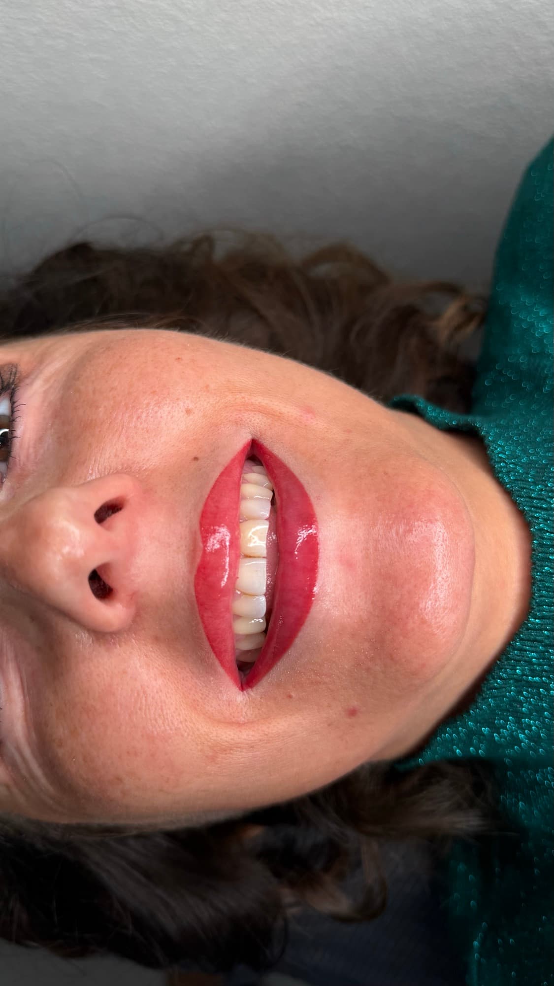 Resultaat van een lipbehandeling.