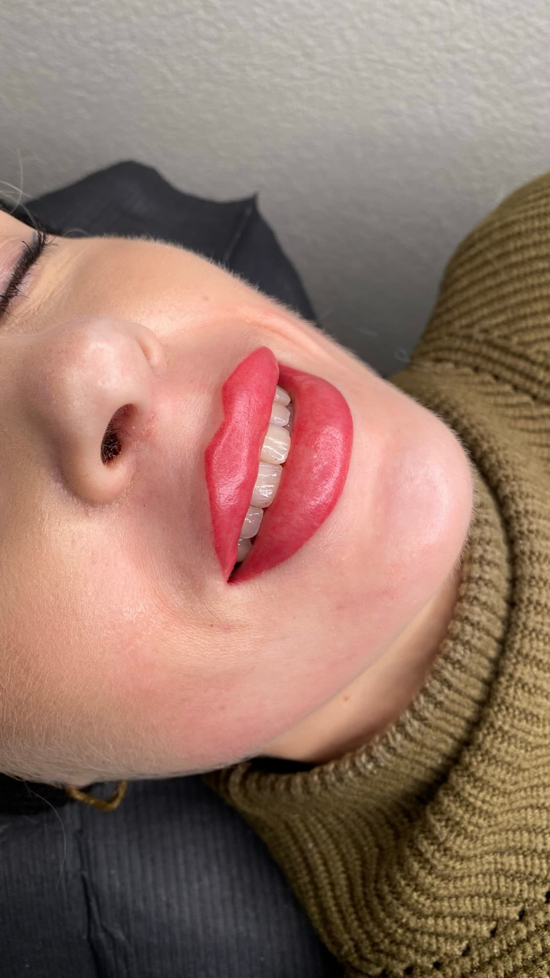 Resultaat van een lipbehandeling.