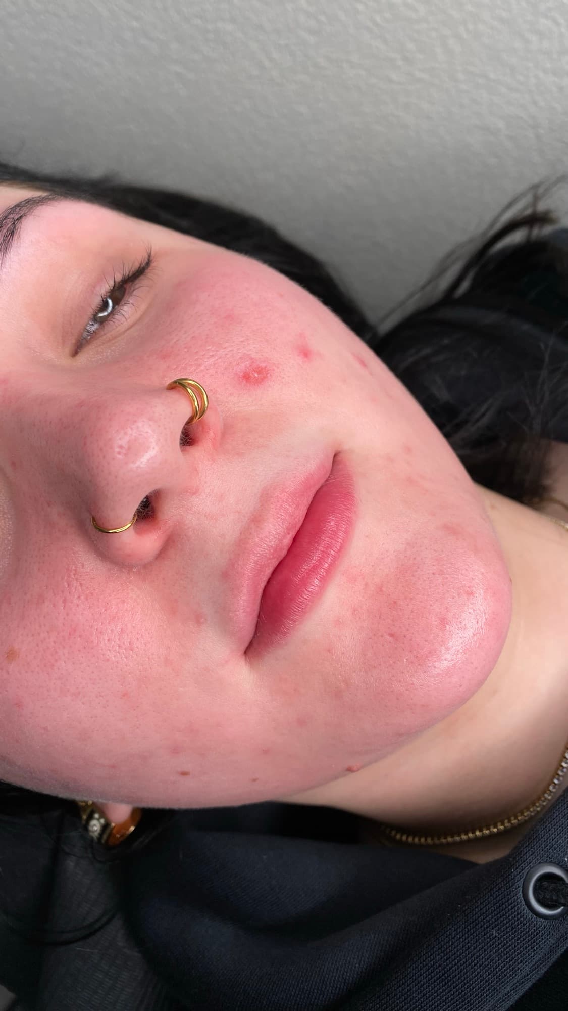Resultaat van een lipbehandeling.