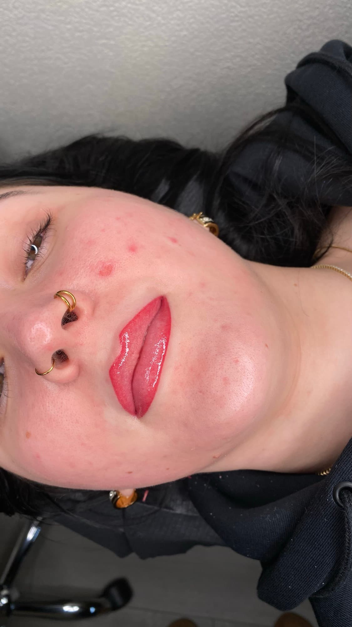 Resultaat van een lipbehandeling.