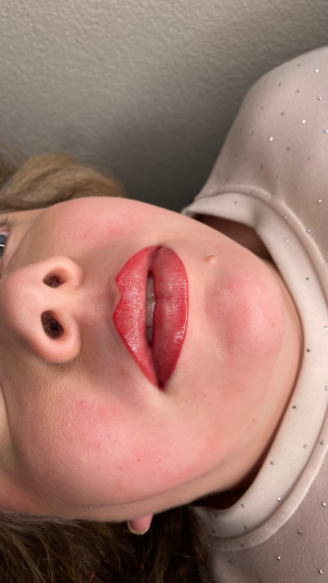 Resultaat van een lipbehandeling.