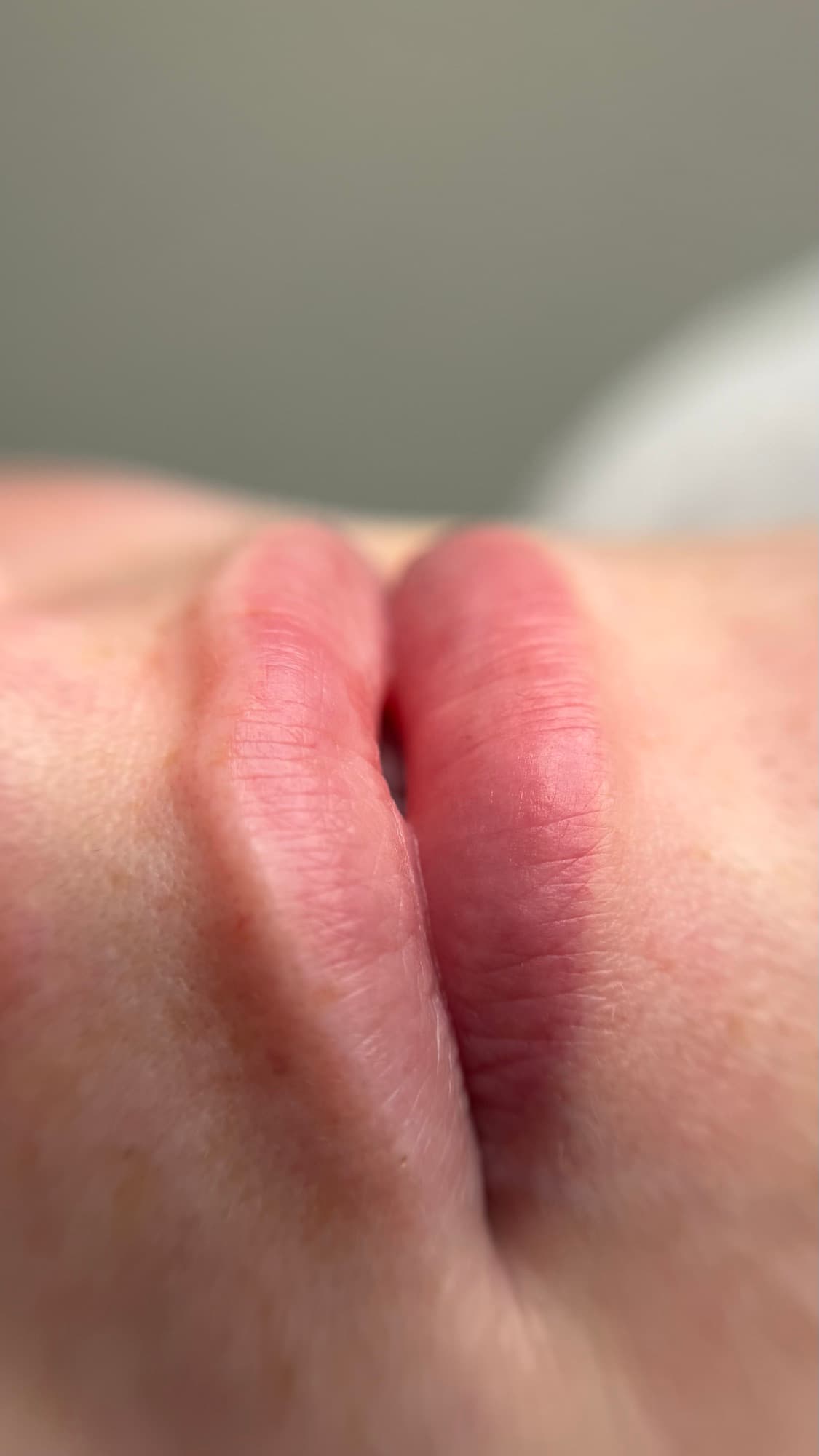 Resultaat van een lipbehandeling.