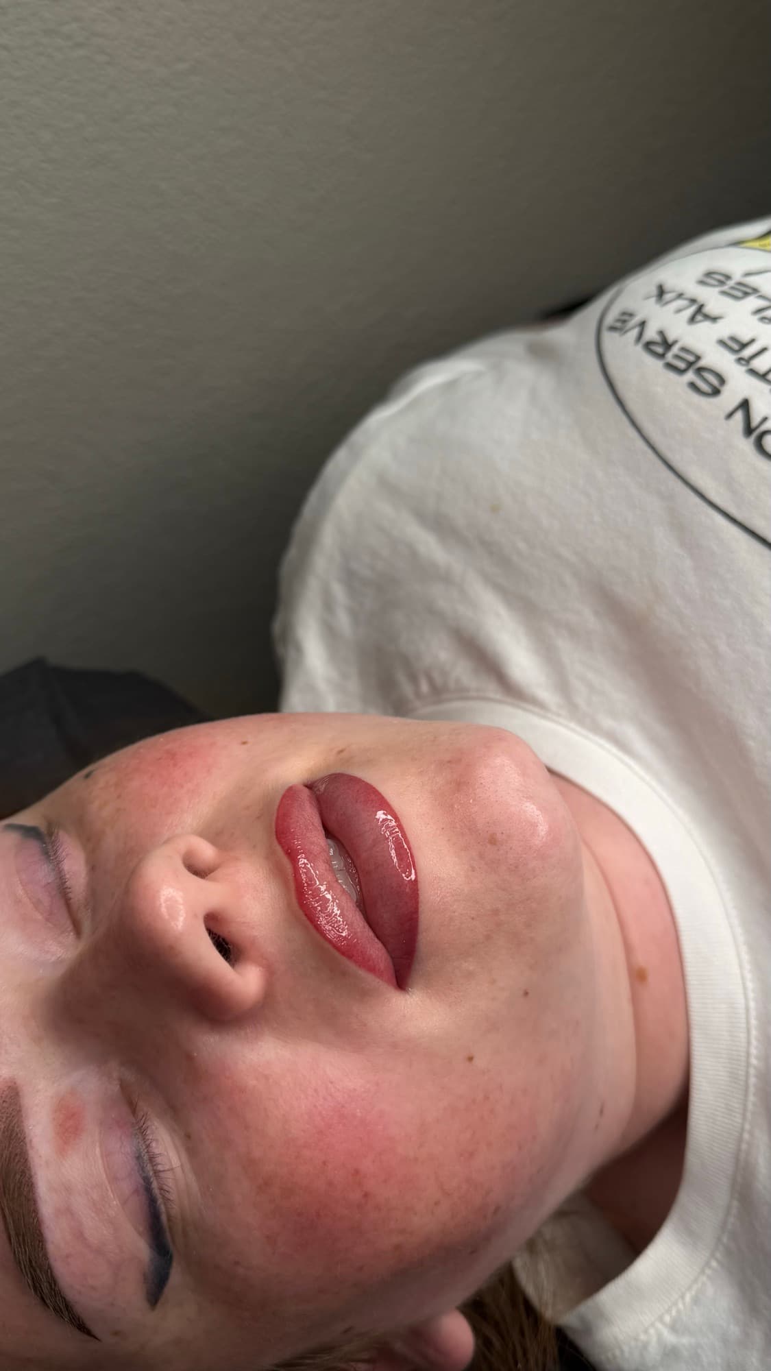 Resultaat van een lipbehandeling.