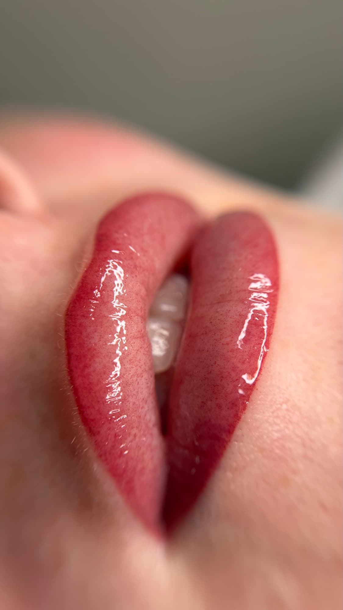 Resultaat van een lipbehandeling.